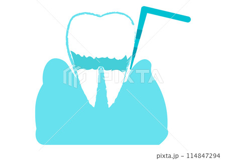 歯周病・歯周ポケットの検査　中等度 114847294