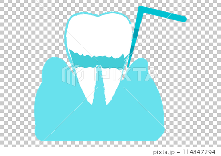 歯周病・歯周ポケットの検査　中等度 114847294