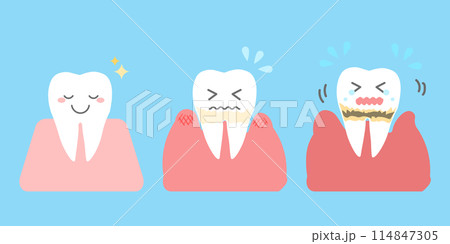 歯周病の進行 歯のシンプルイラスト 114847305