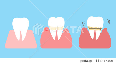 歯周病の進行 歯のシンプルイラスト 歯周病の進行 歯のシンプルイラスト 114847306