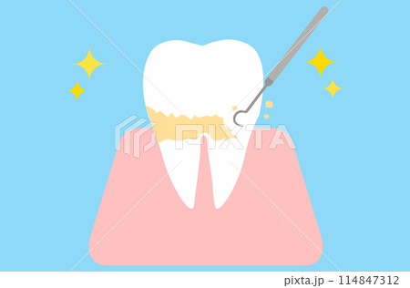 プラーク除去・スケーリングされる歯 114847312