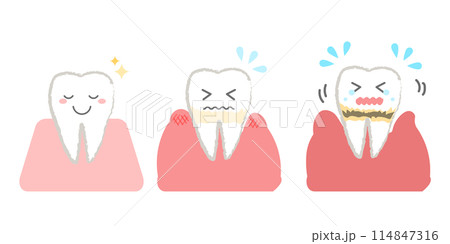 歯周病の進行 歯のシンプルイラスト 114847316