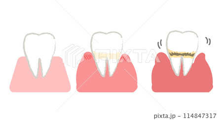 歯周病の進行 歯のシンプルイラスト 114847317