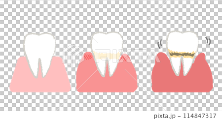 歯周病の進行 歯のシンプルイラスト 114847317