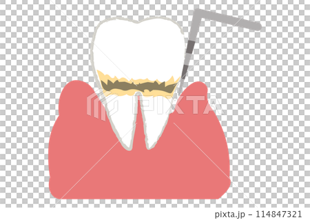 Periodontal disease and periodontal pocket examination: Moderate 114847321