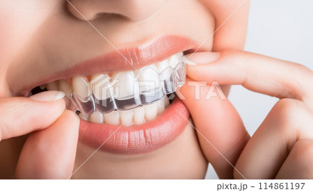 マウスピース矯正 イメージ マウスピース矯正 イメージ 114861197