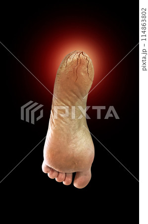 Decorate pictures of cracked heels, dry feet and dry skin on a black background. 114863802