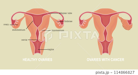 Ovarian cancer refers to any cancerous growth that begins in the ovaries. Ovarian cancer refers to any cancerous growth that begins in the ovaries. 114866827