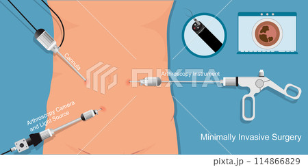 Minimally invasive surgery to access your organs through small portals. 114866829