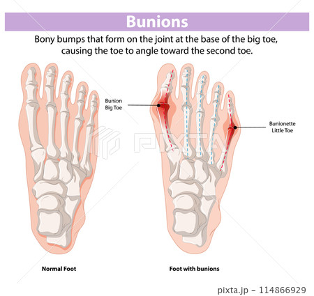 Bunions: Causes and Effects Bunions: Causes and Effects 114866929