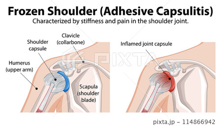 Frozen Shoulder Medical Illustration 114866942