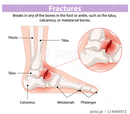 Foot and Ankle Fracture Diagram 114866972