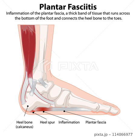 Plantar Fasciitis Medical Illustration 114866977