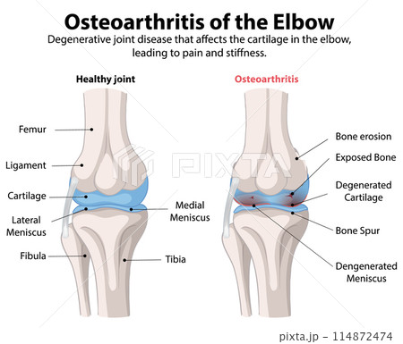Osteoarthritis of the Elbow Osteoarthritis of the Elbow 114872474