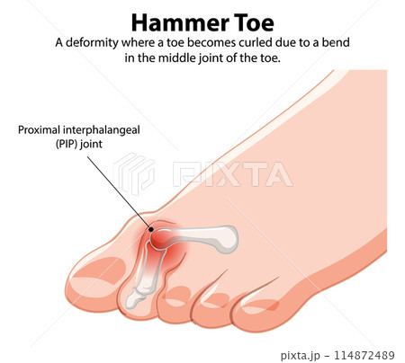 Hammer Toe Medical Illustration 114872489