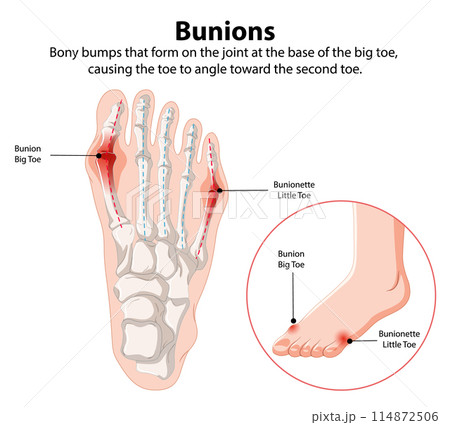 Bunions and Bunionette Illustration 114872506