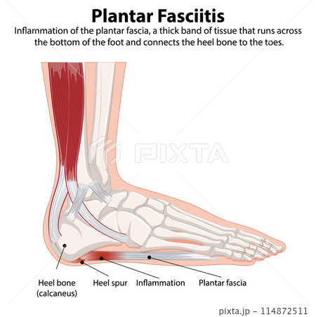 Plantar Fasciitis Foot Anatomy Illustration 114872511