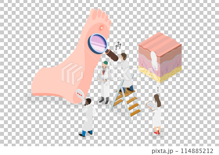 3D Isometric Flat  Conceptual Illustration of Foot Wart, Swollen Skin with Rough, Yellowing Patch 114885212