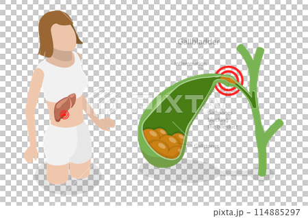 3D Isometric Flat  Conceptual Illustration of Gallstone Disease, Formations in the Gallbladder 114885297