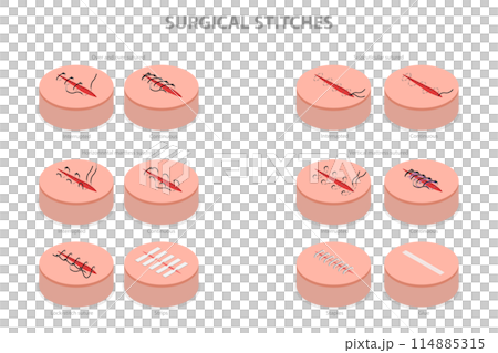 3D Isometric Flat Conceptual Illustration of Surgical Stitches, Medical Suture 3D Isometric Flat Conceptual Illustration of Surgical Stitches, Medical Suture 114885315