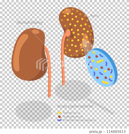 3D Isometric Flat Conceptual Illustration of Acute Pyelonephritis, Urinary Tract Infection 3D Isometric Flat Conceptual Illustration of Acute Pyelonephritis, Urinary Tract Infection 114885613