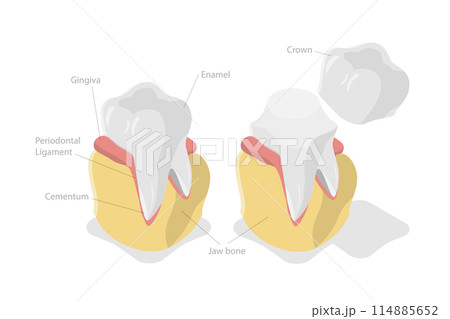 3D Isometric Flat Conceptual Illustration of Dental Crown Restoration, Tooth Prosthesis 3D Isometric Flat Conceptual Illustration of Dental Crown Restoration, Tooth Prosthesis 114885652
