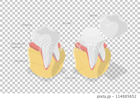 3D Isometric Flat  Conceptual Illustration of Dental Crown Restoration, Tooth Prosthesis 114885652