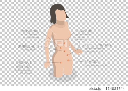 3D Isometric Flat  Illustration of Type Of Abdominal Hernias, Inguinal Hernia 114885744