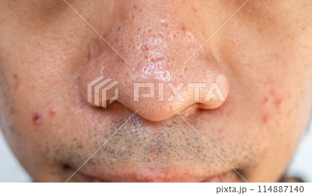 Close up of pores and pimples on men's nose. Nose pores are openings into the skin, where sebaceous glands produce and distribute the skin's natural oil. Close up of pores and pimples on men's nose. Nose pores are openings into the skin, where sebaceous glands produce and distribute the skin's natural oil. 114887140