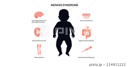Menkes syndrome poster 114911222