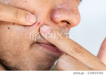 Close up of young man squeezing pimple or acne on his skin. A pimple is a small inflammation or swelling of the skin that may or may not be filled with pus. 114915592