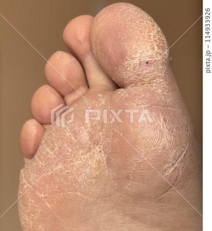 A lot of small cracks and dry flaky skin on the foot. The concept of foot care, pedicure 114933926