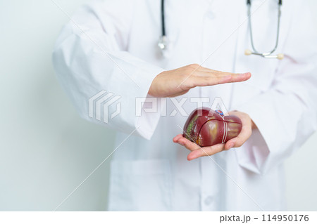 Doctor with human Liver anatomy model. Liver cancer and Tumor, Jaundice, Viral Hepatitis A, B, C, D, E, Cirrhosis, Failure, Enlarged, Hepatic Encephalopathy, Ascites Fluid in Belly and health concept 114950176