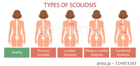 Types of scoliosis, spinal disease. Infographics banner with human scoliosis spine. Healthcare and medicine. Illustration, poster Types of scoliosis, spinal disease. Infographics banner with human scoliosis spine. Healthcare and medicine. Illustration, poster 114953263