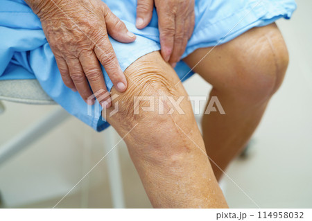 Asian elderly woman patient show her scars surgical total knee joint replacement Suture wound surgery arthroplasty. 114958032
