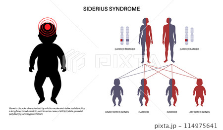 Siderius syndrome scheme Siderius syndrome scheme 114975641