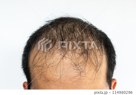 Close up of top view of baldness man scalp. Baldness is related to your genes and male sex hormones. It usually follows a pattern of receding hairline and hair thinning on the crown. 114980296