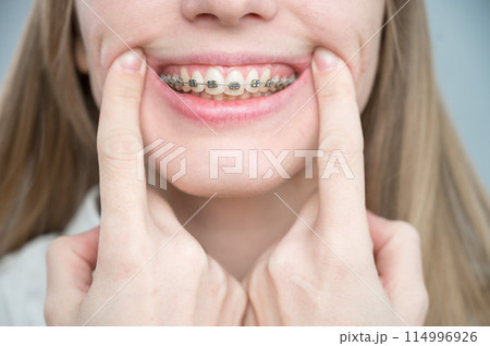 Close-up of a young woman's smile with metal braces on her teeth. Correction of bite 114996926