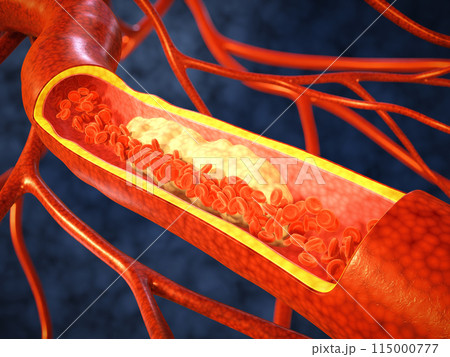 Cholesterol plaque on a blood vessel 115000777