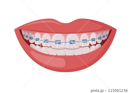 Braces Corrective Orthodontics, smiling female mouth with healthy teeth and braces. Dentistry, dental treatment, orthodontics. Vector. 115081236