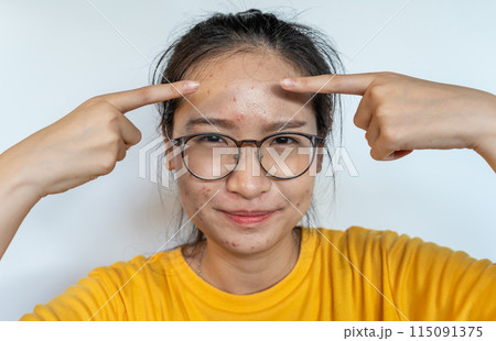 Portrait of unhappy Asian woman pointing to acne inflamed on her forehead. Conceptual shot of Acne and Problem Skin on female face. 115091375