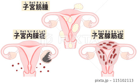 子宮筋腫・子宮腺筋症・子宮内膜症の比較 わかりやすい日本語図解イラスト 115102113