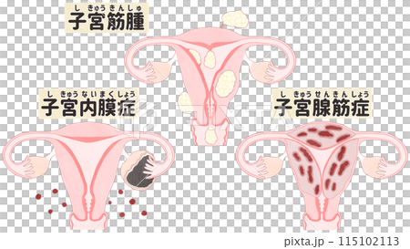 子宮筋腫・子宮腺筋症・子宮内膜症の比較 わかりやすい日本語図解イラスト 115102113