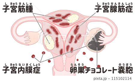 子宮筋腫・子宮腺筋症・子宮内膜症の併発 わかりやすい日本語図解イラストのイラスト素材 [115102114] - PIXTA