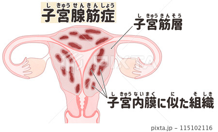 子宮腺筋症 わかりやすい日本語図解イラスト 子宮腺筋症 わかりやすい日本語図解イラスト 115102116