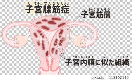 子宮腺筋症 わかりやすい日本語図解イラスト 子宮腺筋症 わかりやすい日本語図解イラスト 115102116