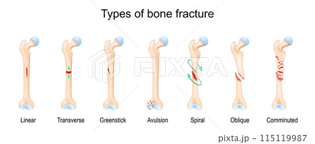 Types of bone fracture. Femur bone. Types of bone fracture. Femur bone. 115119987
