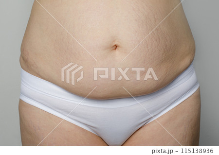 Female belly with striae after pregnancy and childbirth on white background 115138936