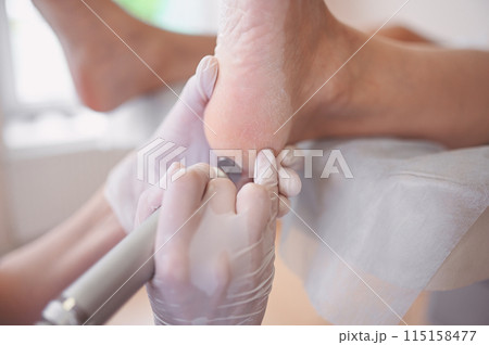Podiatrist using grinding equipment and making procedure polish for feet pedicure. Podology beautician in white gloves cleaning skin of client legs from callus and corn with professional tool. Podiatrist using grinding equipment and making procedure polish for feet pedicure. Podology beautician in white gloves cleaning skin of client legs from callus and corn with professional tool. 115158477