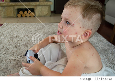 Natural vaccination. Contagious disease. Natural vaccination. Contagious disease. 115163858